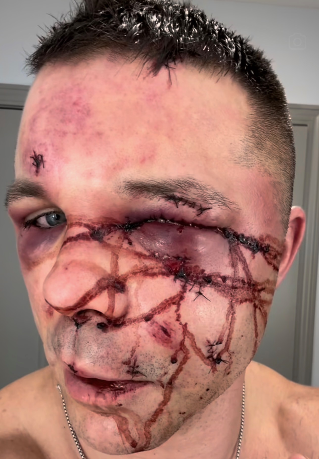 Close-up of Cody Vidal after a bare-knuckle bout, cuts stitched and bruising visible